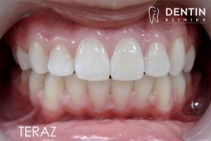 Twarz przed i po leczeniu ortodontycznym