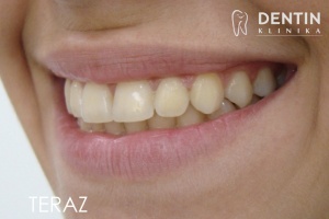 Twarz przed i po leczeniu ortodontycznym
