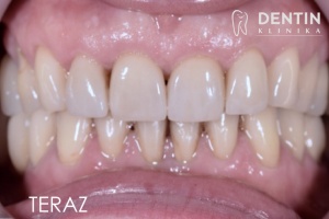 Rekonstrukcja startych zębów - licówki porcelanowe od 2 do2