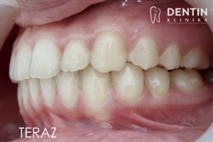 Wpływ leczenia ortodontycznego na profil